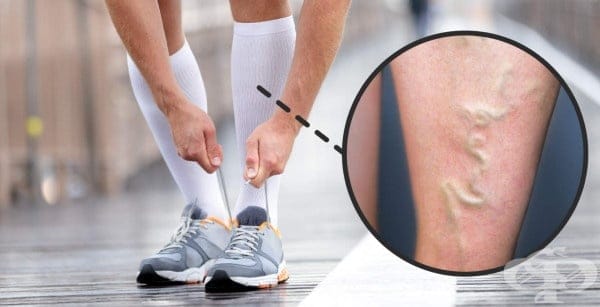 Тромбофлебит или дълбока венозна тромбоза – кога е безобидно и кога опасно?